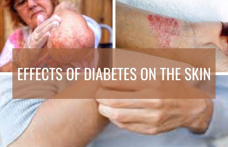 Effects of Diabetes on the Skin