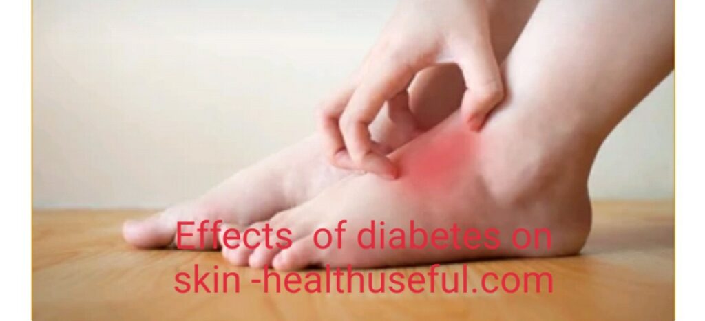 Effects of diabetes on skin -Part 12