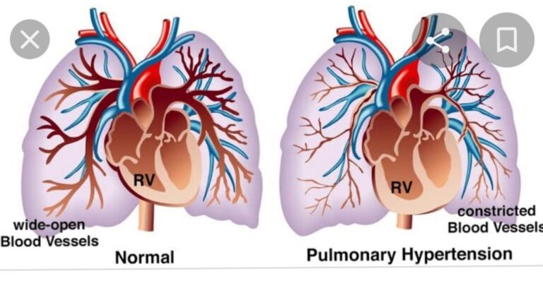 Pulmonary hypertension – Symptoms and causes – Dr.Sagar