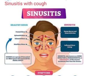 Sinusitis with cough