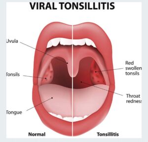 Tonsillitis removal surgery